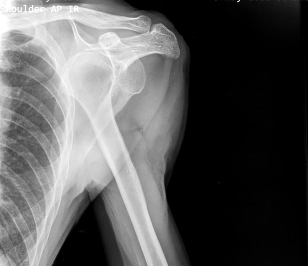 Out of Joint : Managing Shoulder Dislocations with Osteopathy  blog photo