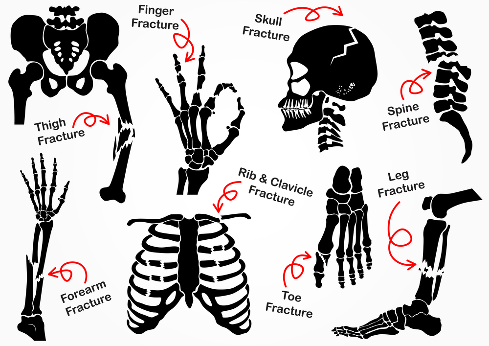 Injury blog: Bone fractures | Altona Meadows Osteopathy