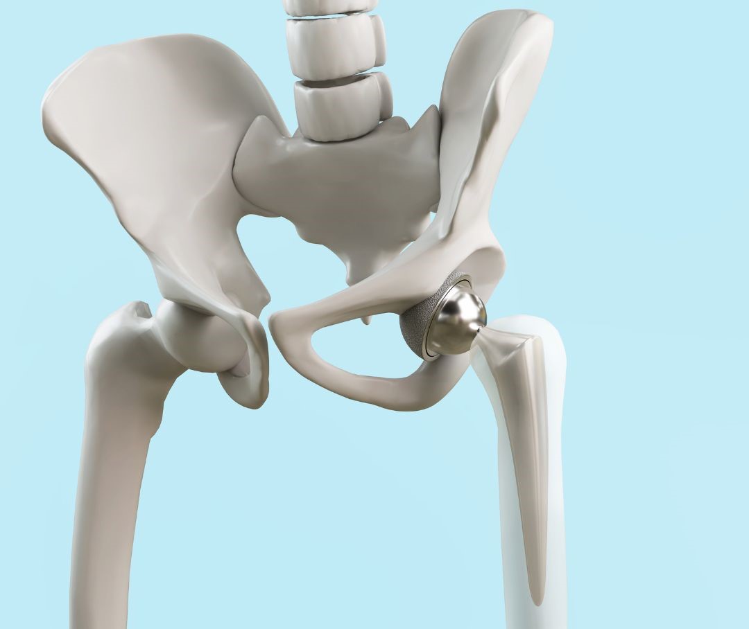 Been Told You Need a Hip Replacement? Don’t Panic – Your Osteopath Is Here to Help!
