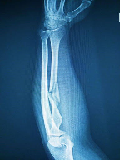 How Osteopathy Can Help You Recover after a Fracture